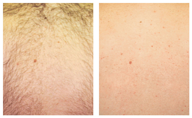 removal hair laser treatment syneron virginia before gentle candela courtesy area